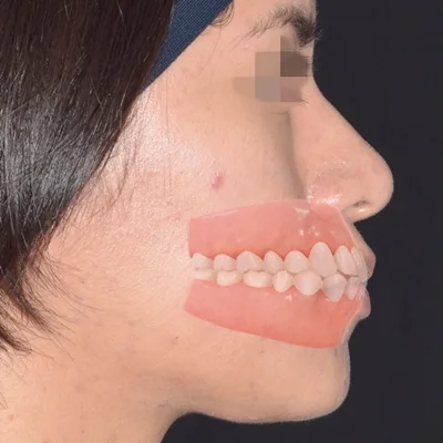 biprotrusion dentaria o boca sobresalida