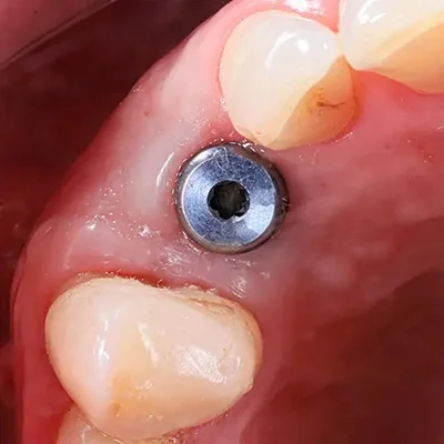 implante dental lima 1