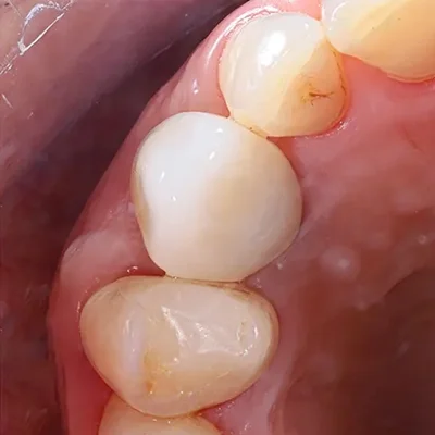 implante dental lima 2
