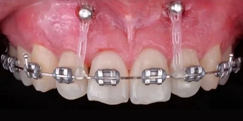microtornillos-en-ortodoncia