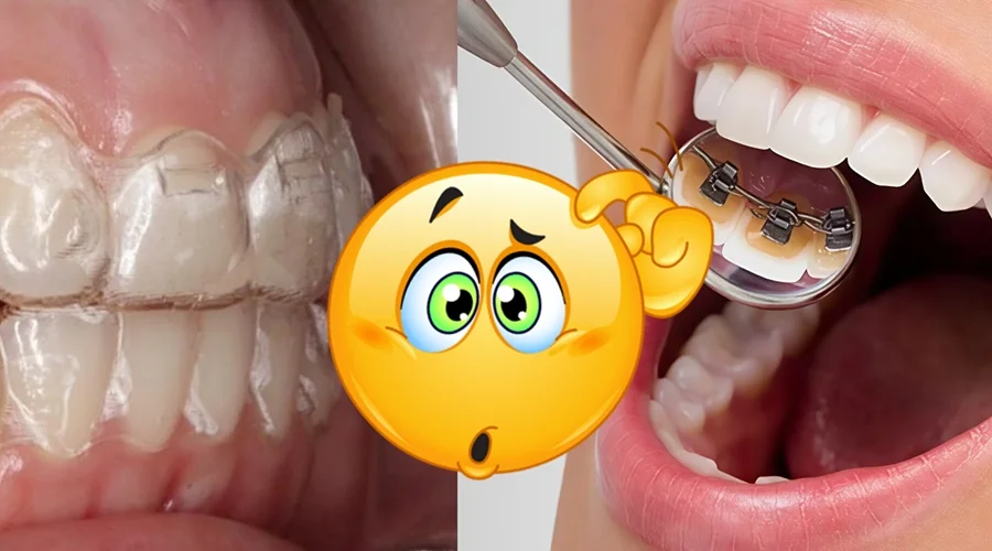 Alternativa a los alineadores dentales