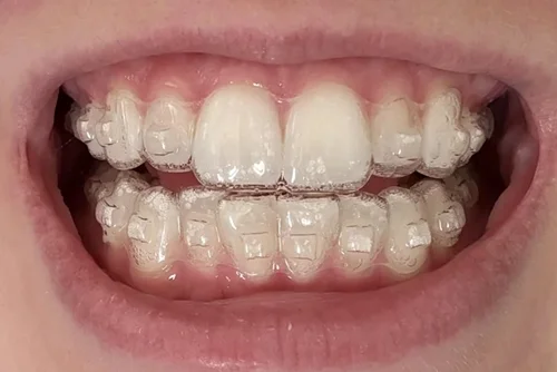 alineadores dentales apariencia