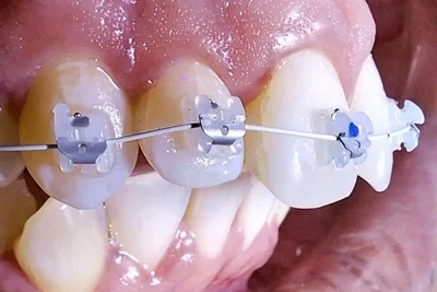 brackets-autoliables-ceramicos-transparentes