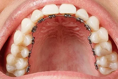 ortodoncia-lingual-alternativa-alineadores-dentales