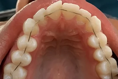 ortodoncia sin brackets con alambres