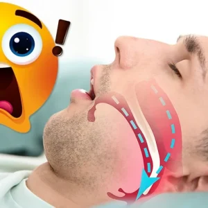 apnea del sueño y tratamiento de expansion maxilar
