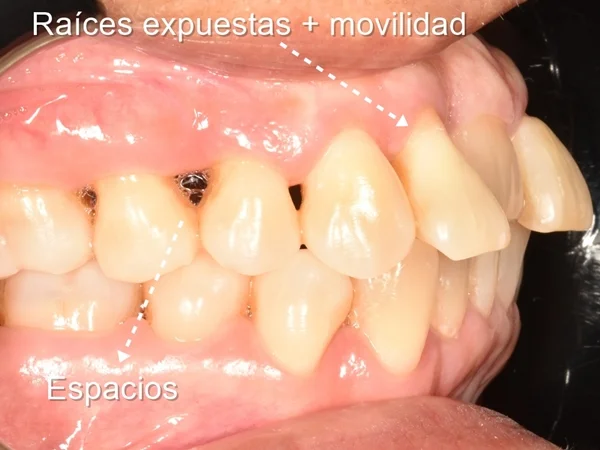 ortodoncia en adultos lima