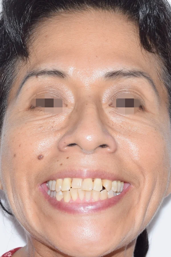 ortodoncia en adultos Antes