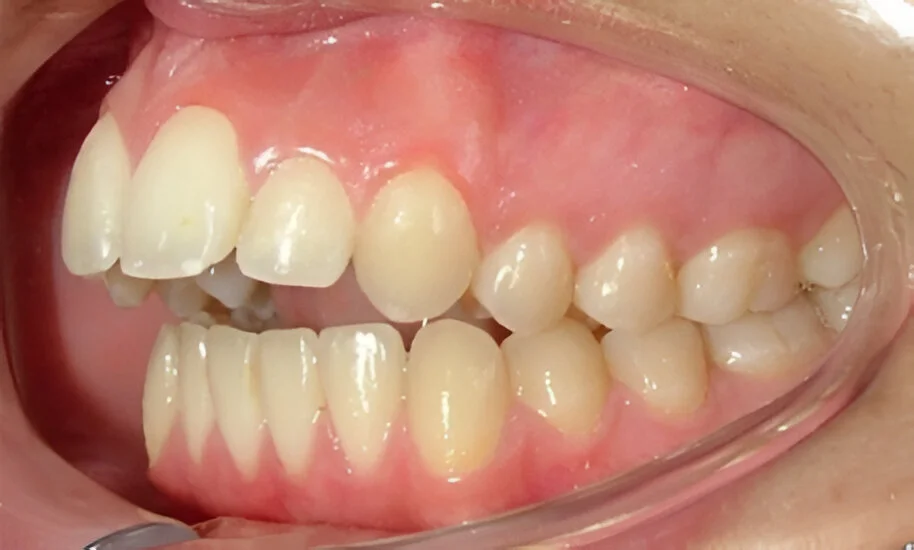 Mordida superior adelantada