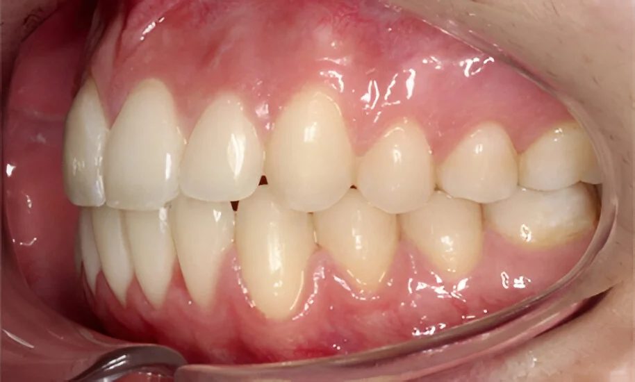 Mordida superior adelantada Solucionado