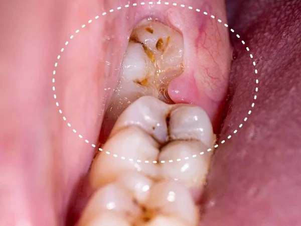 muelas del juicio ortodoncia