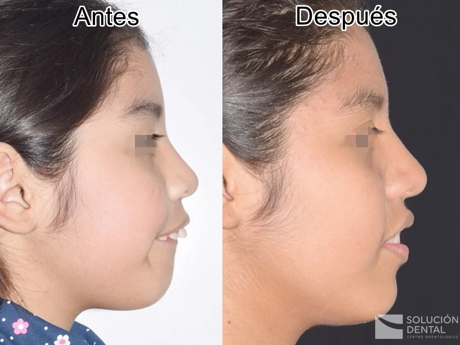 Cambio de perfil en niños