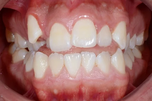 dientes amontonados