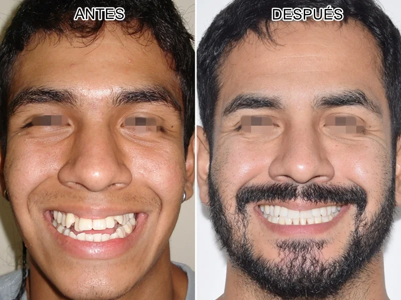 Expansion adultos antes despues