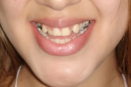 Sonrisa estrecha en expansión maxilar