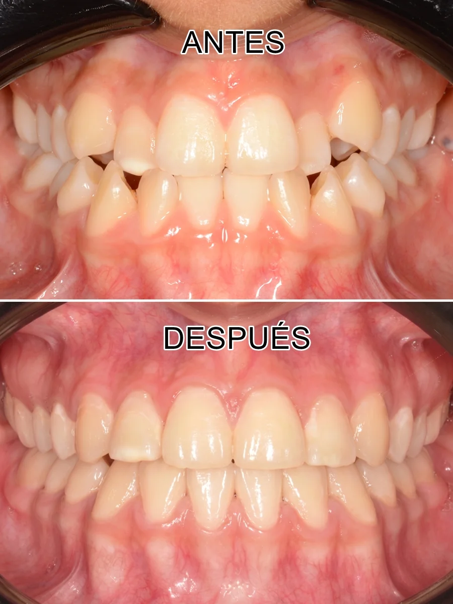 antes-despues-ortodoncia-DIENTES FRONTAL-sonrisa-expansion-maxilar
