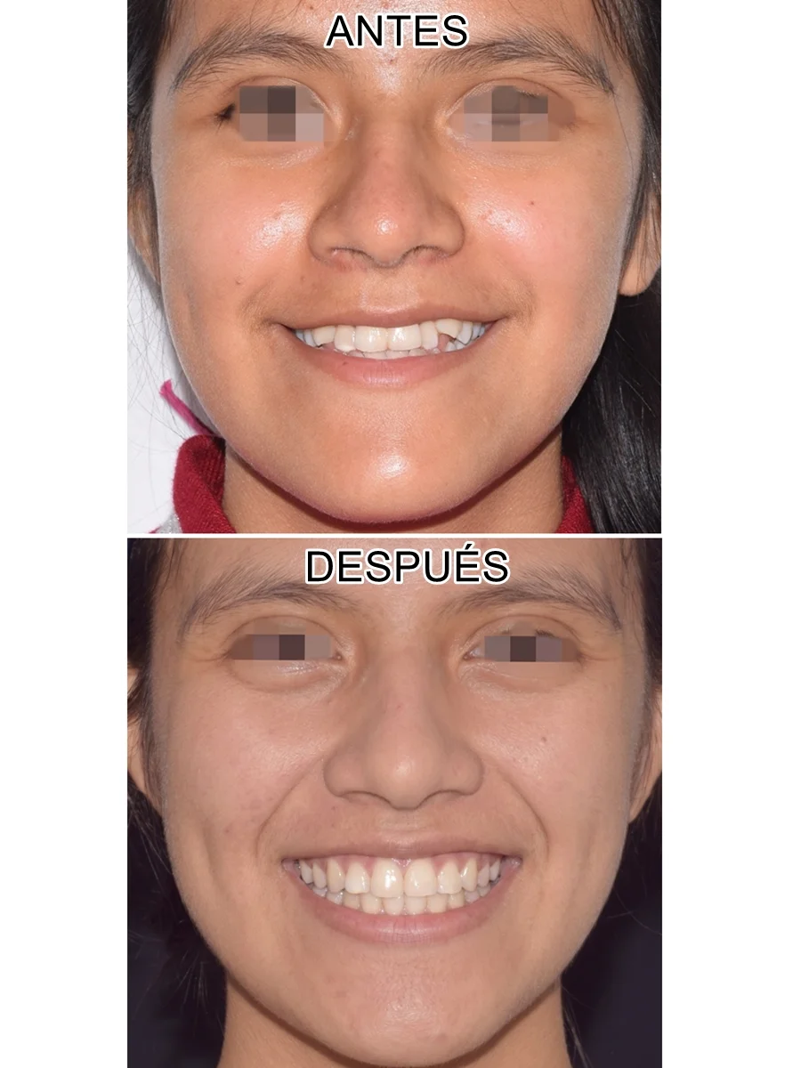 antes-despues-ortodoncia-expansion-maxilar-FOTO FRONTAL Lima Peru