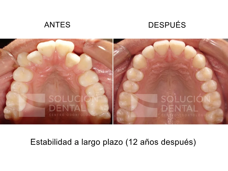 después ortodoncia
