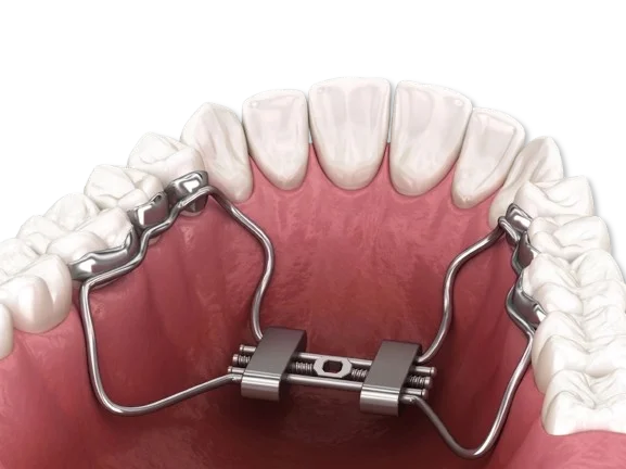 expansion maxilar lima peru PNG