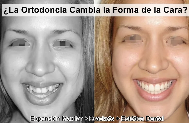 la ortodoncia cambia la forma de la cara