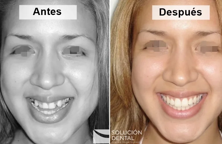 la ortodoncia cambia la forma de la cara - antes después