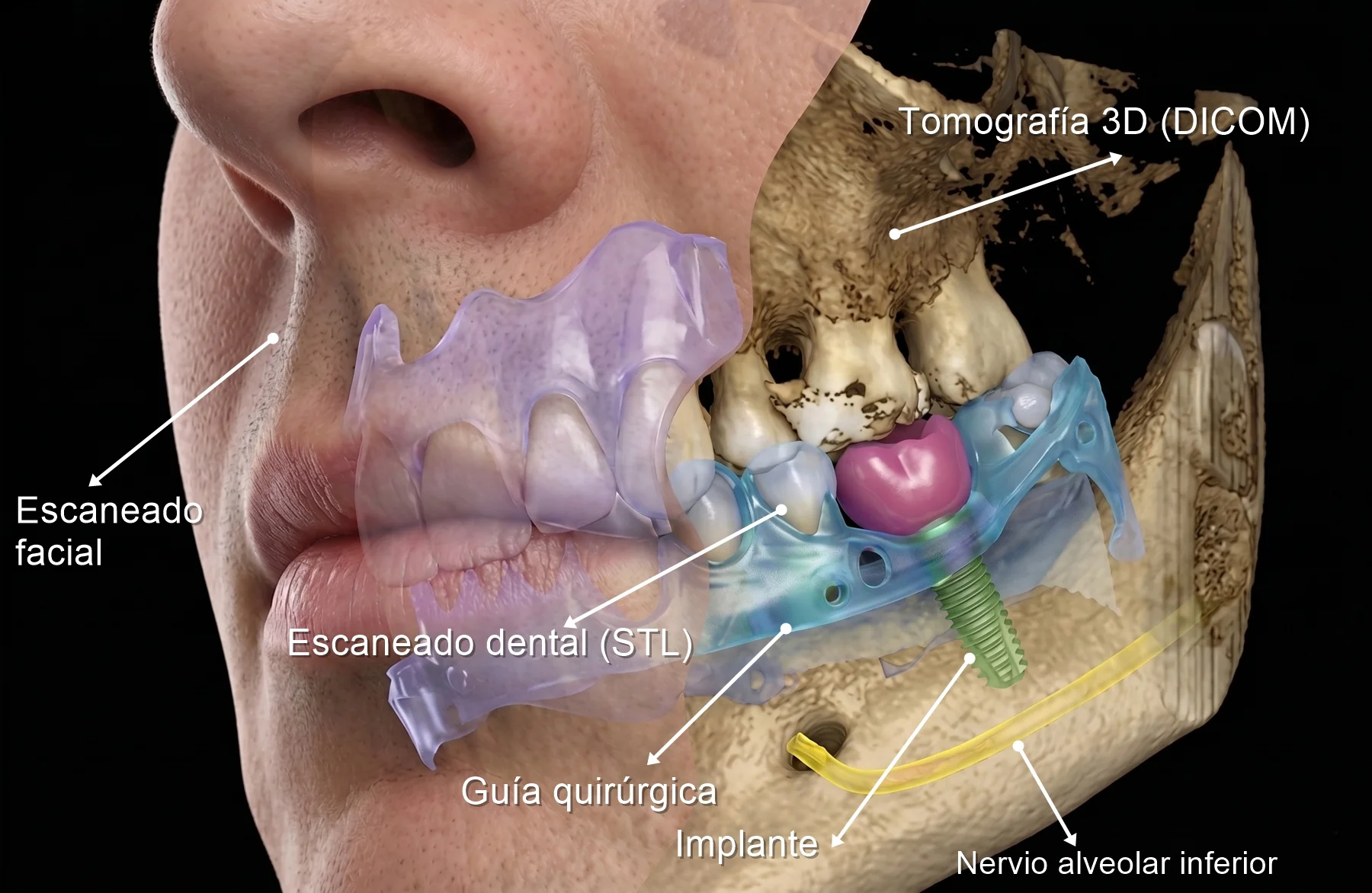 Escaneado dental STL + Tomografia cone beam DICOM
