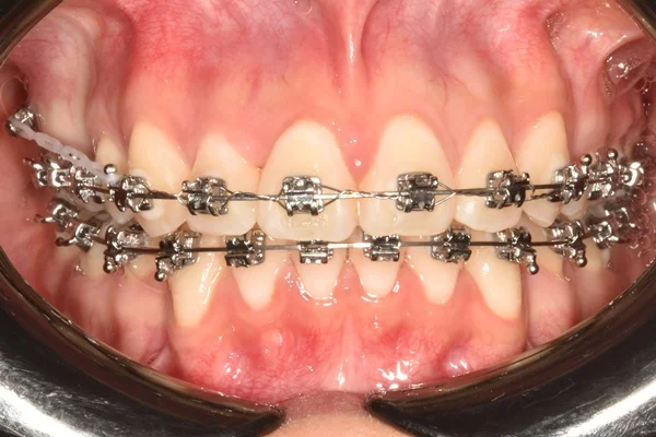 Retratamiento de ortodoncia con brackets reposicionados y mejoría progresiva de la mordida.