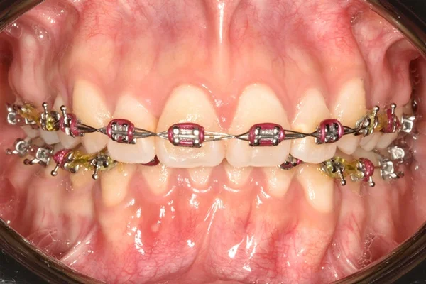 Mordida profunda y posicionamiento inadecuado de brackets antes del retratamiento de ortodoncia.